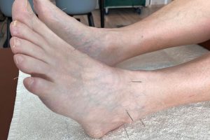 physio-praille-therapies-complementaires-geneve-lancy-acupuncture